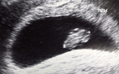 İlk 3 Ayda Ultrasonografi